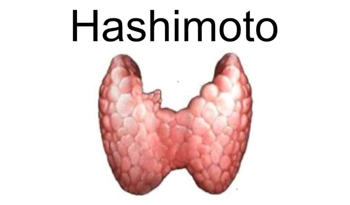 Artikel update Hashimoto
