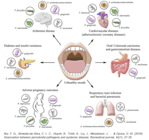 Verband tussen tandvleesontsteking (gingivitis, parodontitis) en ziekten