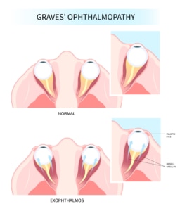 oogziekte van graves graves orbitopathie graves ophthalmopathie of oftalmopathie afgekort go